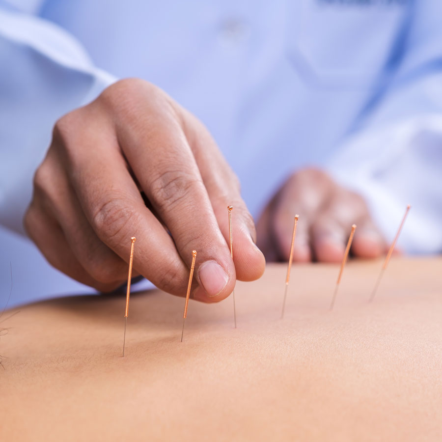 Acupuntura - Neuro Integrada